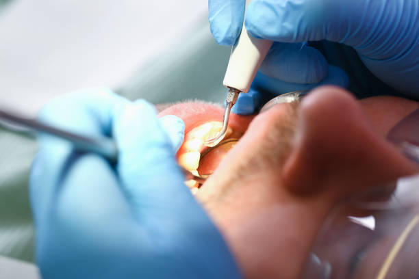 Best Emergency Root Canal Treatment in Tequesta, FL